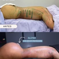 Antes y después glúteo